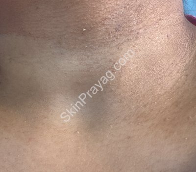 Skin Tag Removal