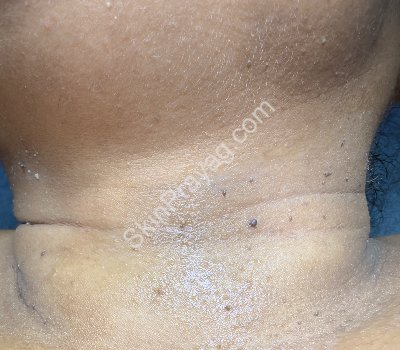 Skin Tag Removal