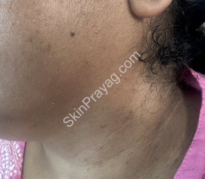 After removal of skin tags, seborrheic keratoses