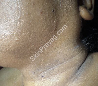 Before removal of skin tags, seborrheic keratoses