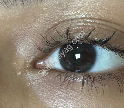 Before milia removal