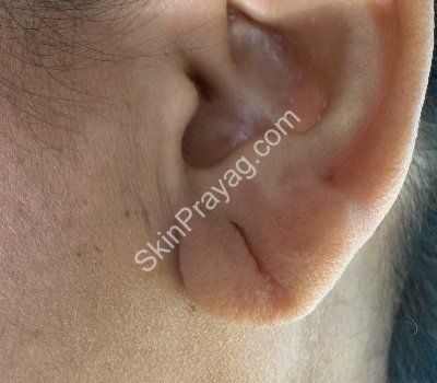 Before ear lobe repair