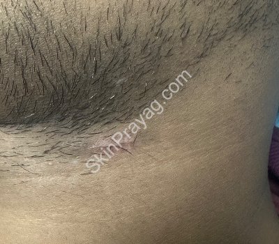 After Molluscum removal