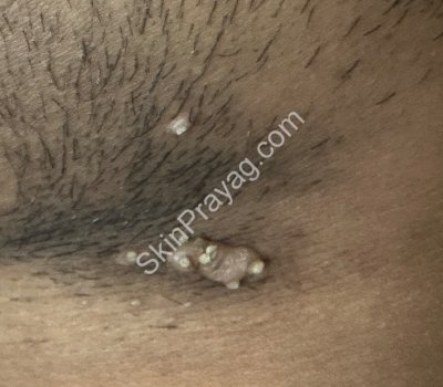 Before Molluscum removal