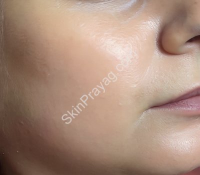 After skin booster treatment