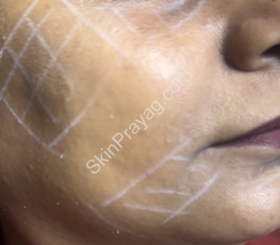 Before skin booster treatment