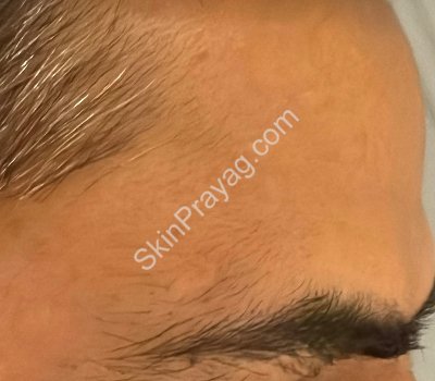 Pilomatricoma removal results , Rohini, Delhi