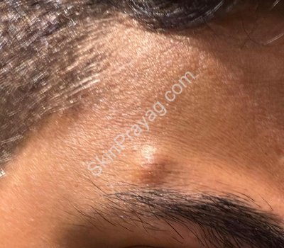 Pilomatricoma removal, Rohini, Delhi