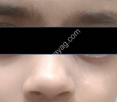 Pilomatricoma removal, Rohini , Delhi