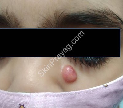 Pilomatricoma removal, Rohini, Delhi