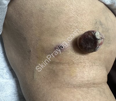 Skin papilloma after removal