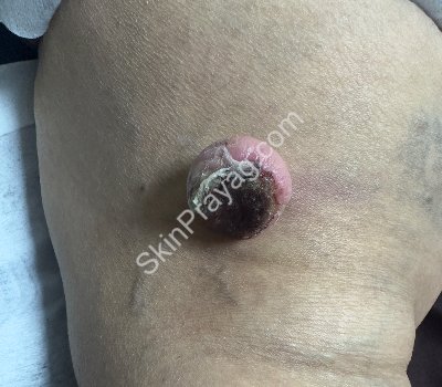 Skin papilloma before