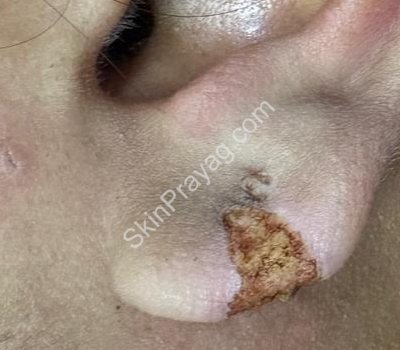 Ear keloid-after CO2 laser removal Rohini