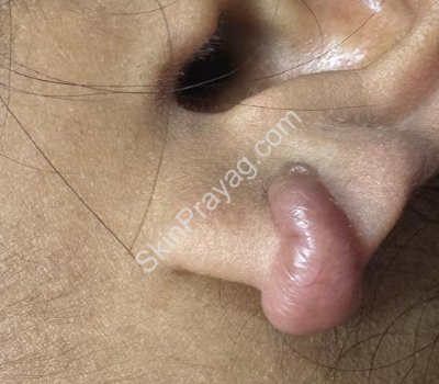 Ear keloid before treatment Rohini Delhi