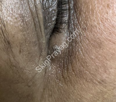 Skin Tag Removal