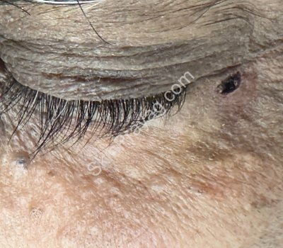 Skin after removal of eyelid papilloma at SkinPrayag Dermatology Clinic, Rohini, Delhi