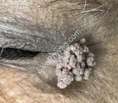 Skin papilloma on the eyelid before treatment at SkinPrayag Dermatology Clinic, Rohini, Delhi