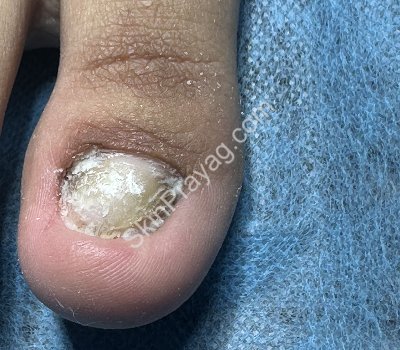 Fungal nail infection treatment