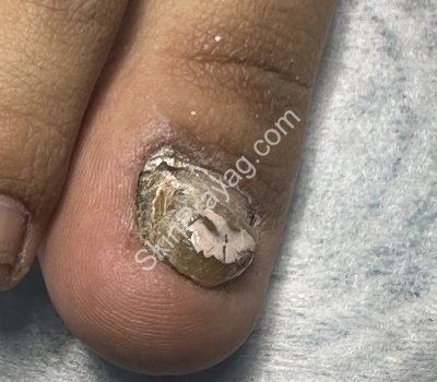 Fungal nail infection treatment