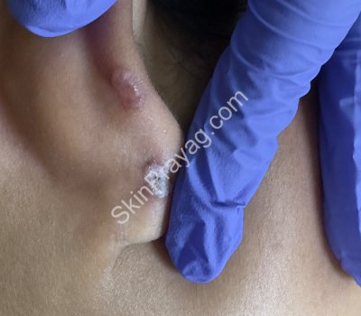 After Ear keloid removal with CO2 laser /Rohini