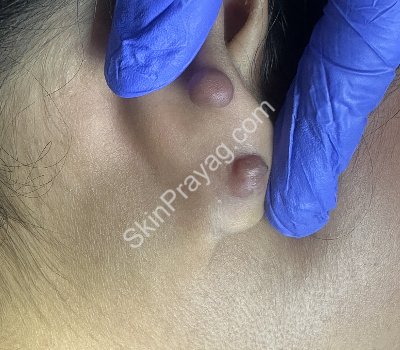 Before ear lobe keloid removal with CO2 laser/ Rohini