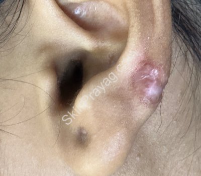 After Ear keloid removal with CO2 laser /Rohini