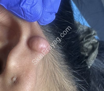 Before ear lobe keloid removal with CO2 laser/ Rohini