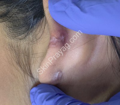 After Ear keloid removal with CO2 laser /Rohini