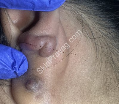 Before ear lobe keloid removal with CO2 laser/ Rohini